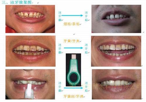 美白洁牙棒洁牙擦，牙齿清洁，洁牙DIY